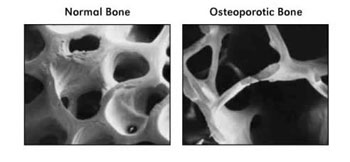 osteoporosis1[1]